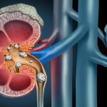 Calcoli renali, nuovo trattamento con impulsi sonori può distruggerli