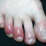 Geloni (pernioni, eritema pernio): sintomi, fattori di rischio, terapia, diagnosi, prevenzione e complicazioni