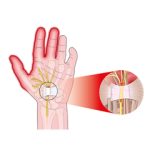 La sindrome del tunnel carpale: sintomi, cause, diagnosi, cura e terapia