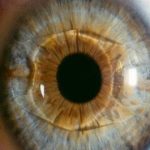 Miopia: una soluzione dalle lenti intraoculari
