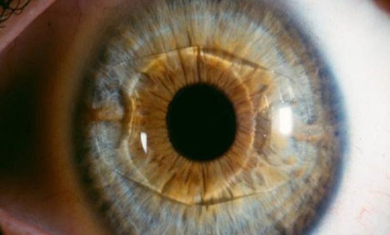 Miopia: una soluzione dalle lenti intraoculari