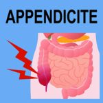 Appendicite: sintomi, cause, diagnosi, terapia, prevenzione e complicazioni 1