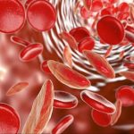 Beta talassemia: guarigione definitiva nel 90% dei casi grazie alla terapia genica