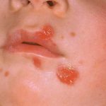 Impetigine: sintomi, cause, diagnosi e terapia