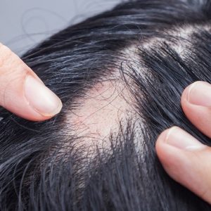 Alopecia areata, Fda approva farmaco che fa ricrescere i capelli