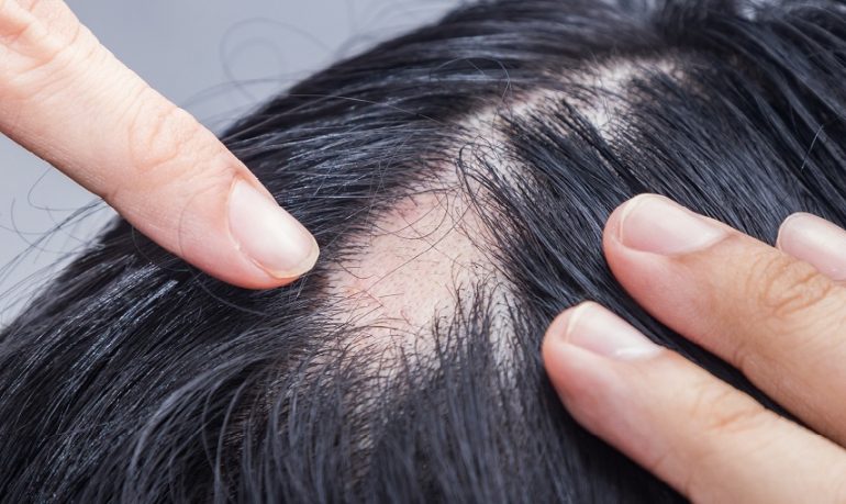 Alopecia areata, Fda approva farmaco che fa ricrescere i capelli