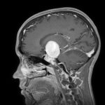 Aneurisma gigante di 4 centimetri nel cervello: intervento salvavita per un giovane 24enne
