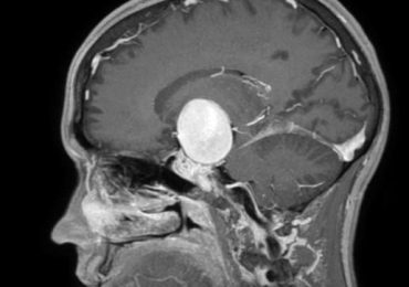 Aneurisma gigante di 4 centimetri nel cervello: intervento salvavita per un giovane 24enne
