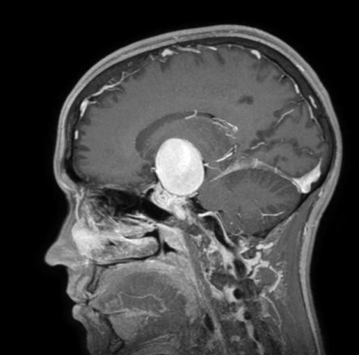 Aneurisma gigante di 4 centimetri nel cervello: intervento salvavita per un giovane 24enne