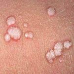 Condilomi: sintomi, cause, diagnosi, terapia, prevenzione e complicazioni