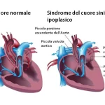 La sindrome del cuore sinistro ipoplasico: sintomi, trattamento e diagnosi