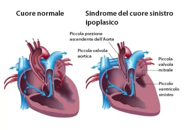 La sindrome del cuore sinistro ipoplasico: sintomi, trattamento e diagnosi