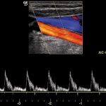 L'ecocolordoppler: cos'è e come interpretare i risultati 1