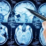 Trauma cranico, nuovo test sul sangue può rivoluzionare la pratica clinica