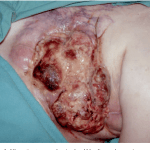 Infermieristica in Wound Care: Le fungating wounds