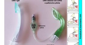 L’utilizzo della maschera laringea in ambito neonatale: indicazioni, procedure di inserimento, complicanze 1