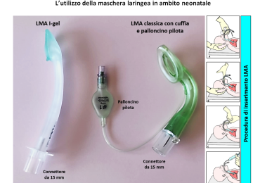 L’utilizzo della maschera laringea in ambito neonatale: indicazioni, procedure di inserimento, complicanze 1