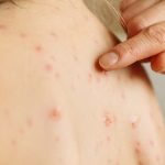 Morbillo, sviluppato sensore che rileva il virus nella saliva