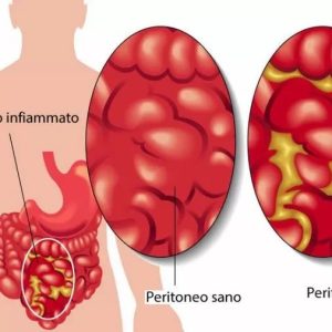 La peritonite: sintomi, cause, diagnosi, terapia e prevenzione