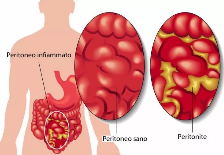 La peritonite: sintomi, cause, diagnosi, terapia e prevenzione