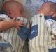 Sindrome da trasfusione feto-fetale, due gemellini operati in utero alla 26esima settimana di gestazione