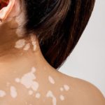 Vitiligine: i benefici di ruxolitinib in crema