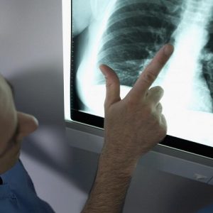 Embolia polmonare, Gise: "Serve una rete italiana per le terapie. Interventi all'avanguardia solo nel 2% delle strutture"
