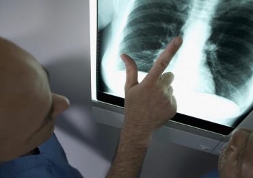 Embolia polmonare, Gise: "Serve una rete italiana per le terapie. Interventi all'avanguardia solo nel 2% delle strutture"
