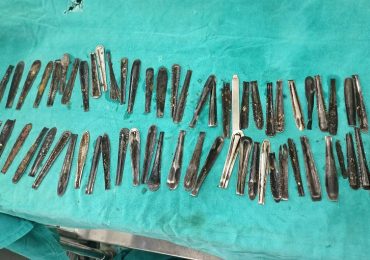 India, 63 manici di cucchiaio ingeriti in un anno: l'incredibile storia di un uomo affetto da picacismo