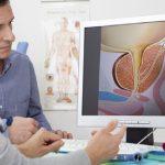 Iperplasia prostatica, 4 nuove tecniche post-intervento possono "salvare" l'eiaculazione