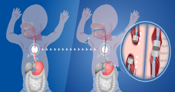 Magneti al posto della chirurgia per riparare l'esofago dei bambini: la nuova tecnica utilizzata al Bambino Gesù