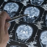 Negligenza motoria: lo strano caso dell'uomo diventato mancino dopo un tumore al cervello
