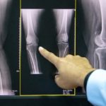Osteoporosi grave: a Genova il primo farmaco che rigenera le ossa