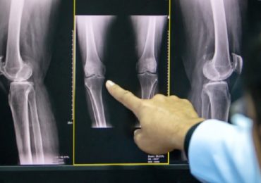 Osteoporosi grave: a Genova il primo farmaco che rigenera le ossa