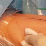 PICC-port: conosciamolo meglio