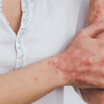 Psoriasi, per curarsi c'è anche la piattaforma con l'app