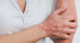 Psoriasi, per curarsi c'è anche la piattaforma con l'app