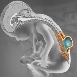 Spina bifida, tre bebè nascono sani grazie a un intervento in utero con cerotto di staminali