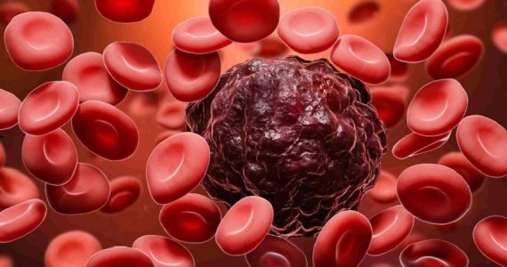 Tumori del sangue: CAR-T e anticorpi bispecifici rivoluzionano la cura