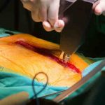 Ferite in cardiochirurgia: problematiche collegate alle infezioni