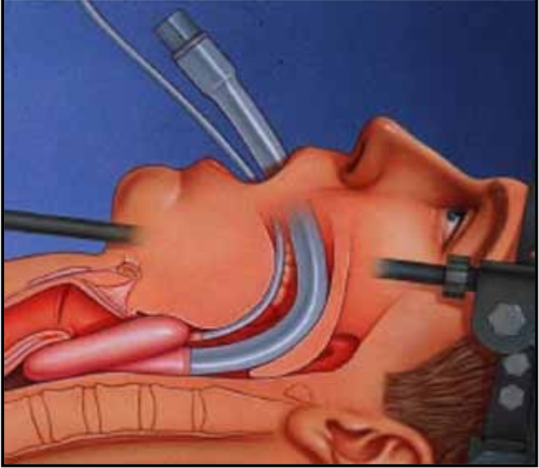 Infermiere specialista in emergenza urgenza: la maschera laringea