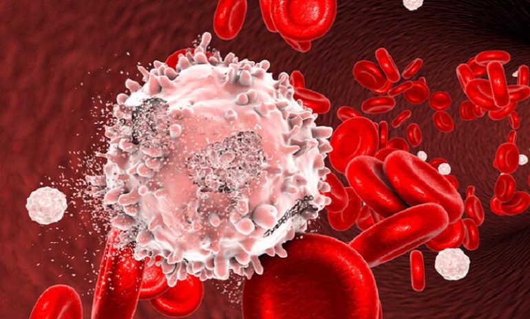 Cellule CAR - Natural Killer: la nuova frontiera della cura "pronta all'uso" per la leucemia mieloide acuta