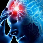 Emorragia cerebrale: cause, sintomi, diagnosi e terapia