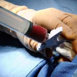 Guarigione da Hiv dopo trapianto di staminali: nuovo caso in Germania