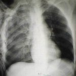 Il trauma toracico