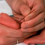 L'emogasanalisi da prelievo di sangue capillare nel neonato
