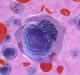 Leucemia mieloide acuta, nuova terapia aumenta la sopravvivenza di 13 volte