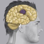 Cavernomi cerebrali, in Italia ne è affetta circa una persona ogni 200