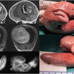 Cina, feto di gemello "parassita" asportato dal cervello di una bimba