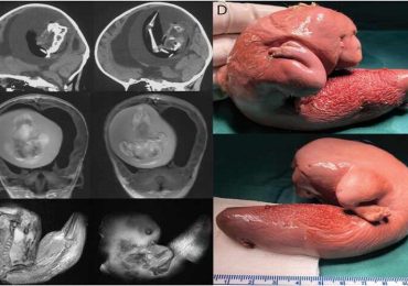 Cina, feto di gemello "parassita" asportato dal cervello di una bimba